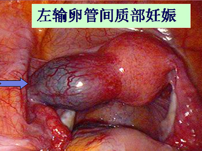 郑州供卵生男孩包成功费用多少钱附成功率及费用介绍