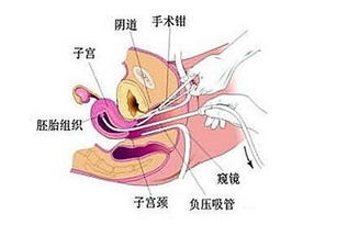 为什么有些人供卵试管婴儿移植有感觉疼