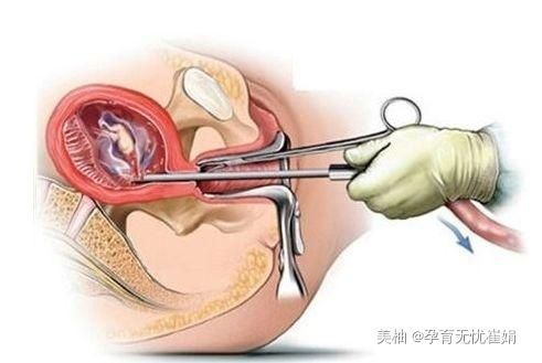 为什么有些人供卵试管婴儿移植有感觉疼