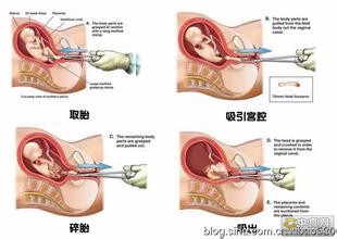 北京市立医院试管QQ群做试管代怀的步骤要了解哪些事儿？